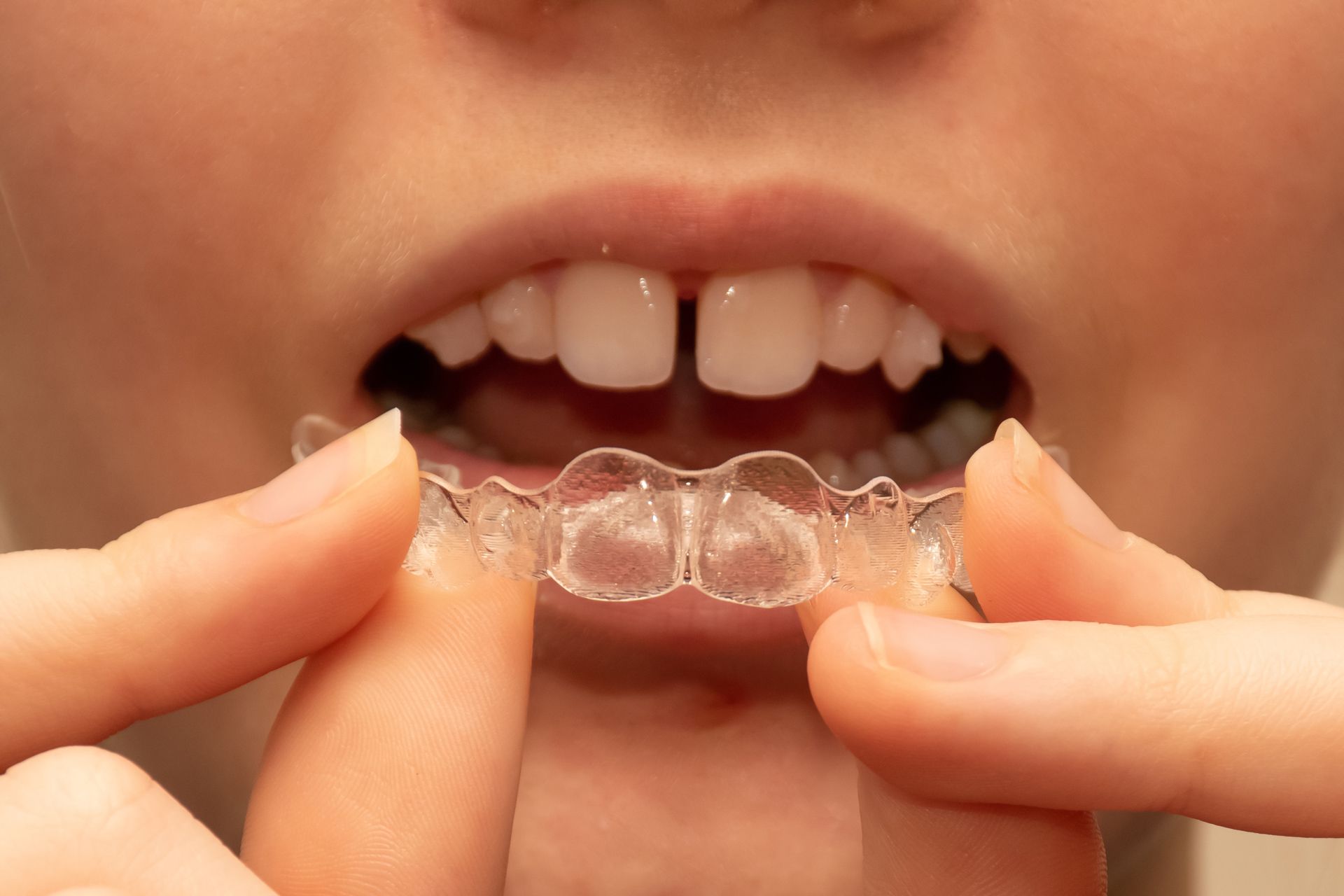 A person is holding a clear brace in their mouth.