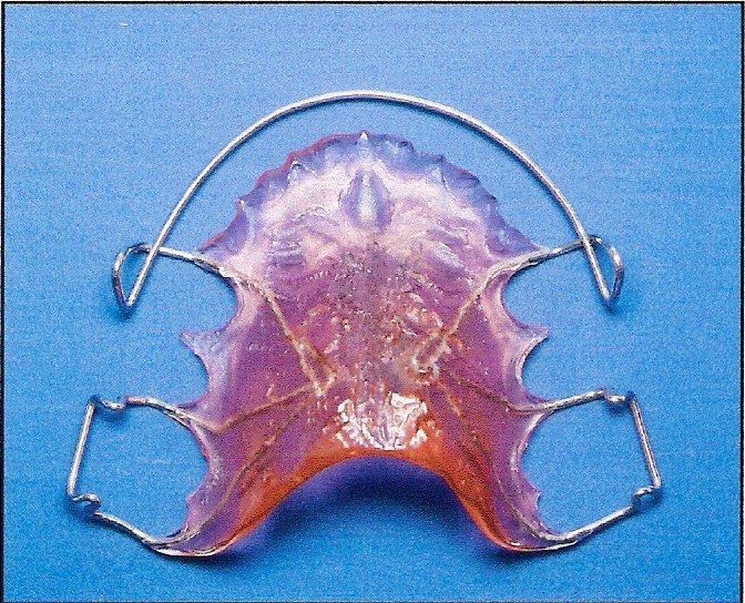 A purple and orange dental retainer on a blue surface