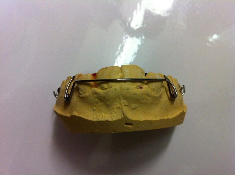 A model of a tooth with a metal bar attached to it