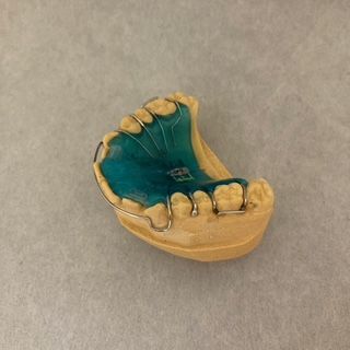 A model of a person 's teeth with braces on them.