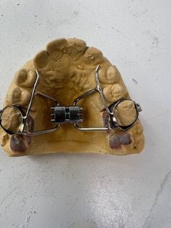 A close up of a model of a tooth with braces on it.