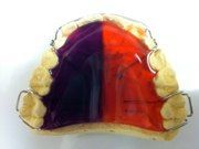 A close up of a red and purple dental retainer on a white surface.