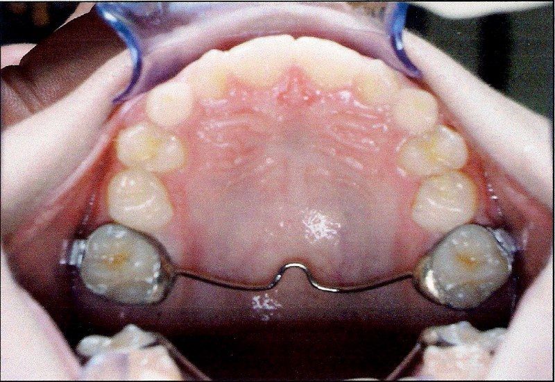 A close up of a person 's mouth with braces on their teeth.