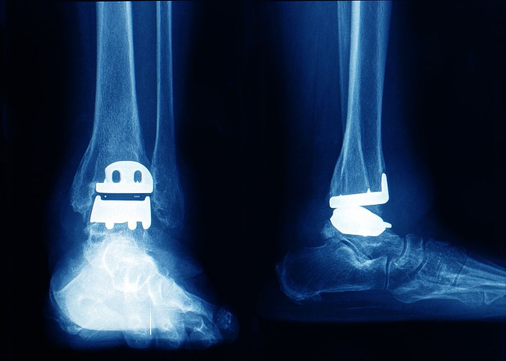 Total Ankle Replacement