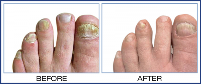 Tolcylen Before/After
