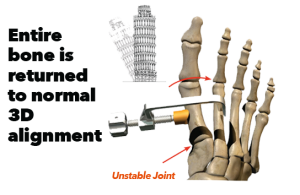 Entire Bone is Returned to Normal 3D Alignment