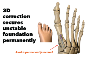 3D Correction Secures Unstable Foundation Permanently