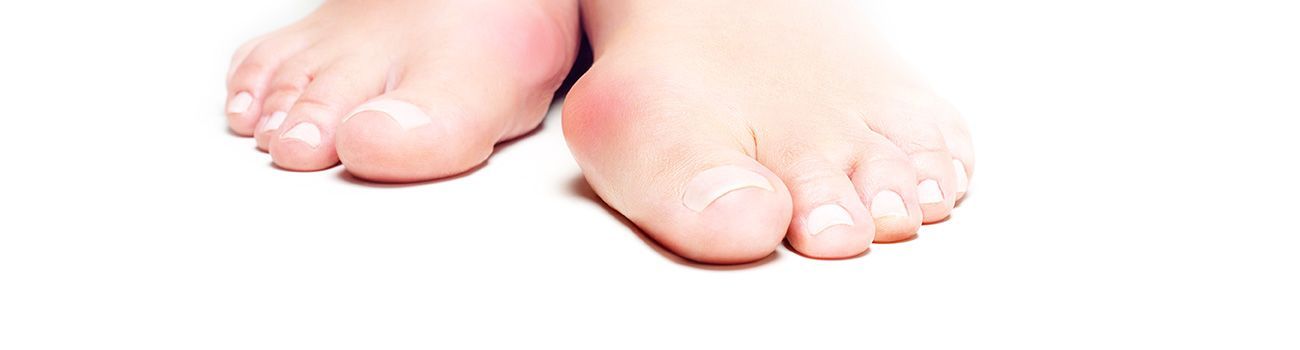 Lapiplasty® 3D Bunion Correction