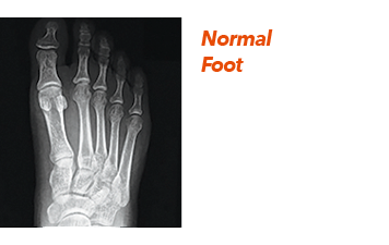 Normal Foot