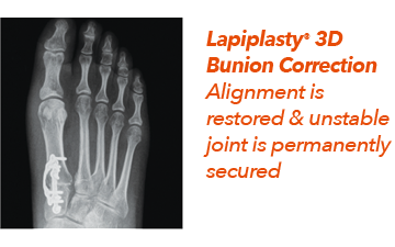 Lapiplasty 3D Bunion Correction