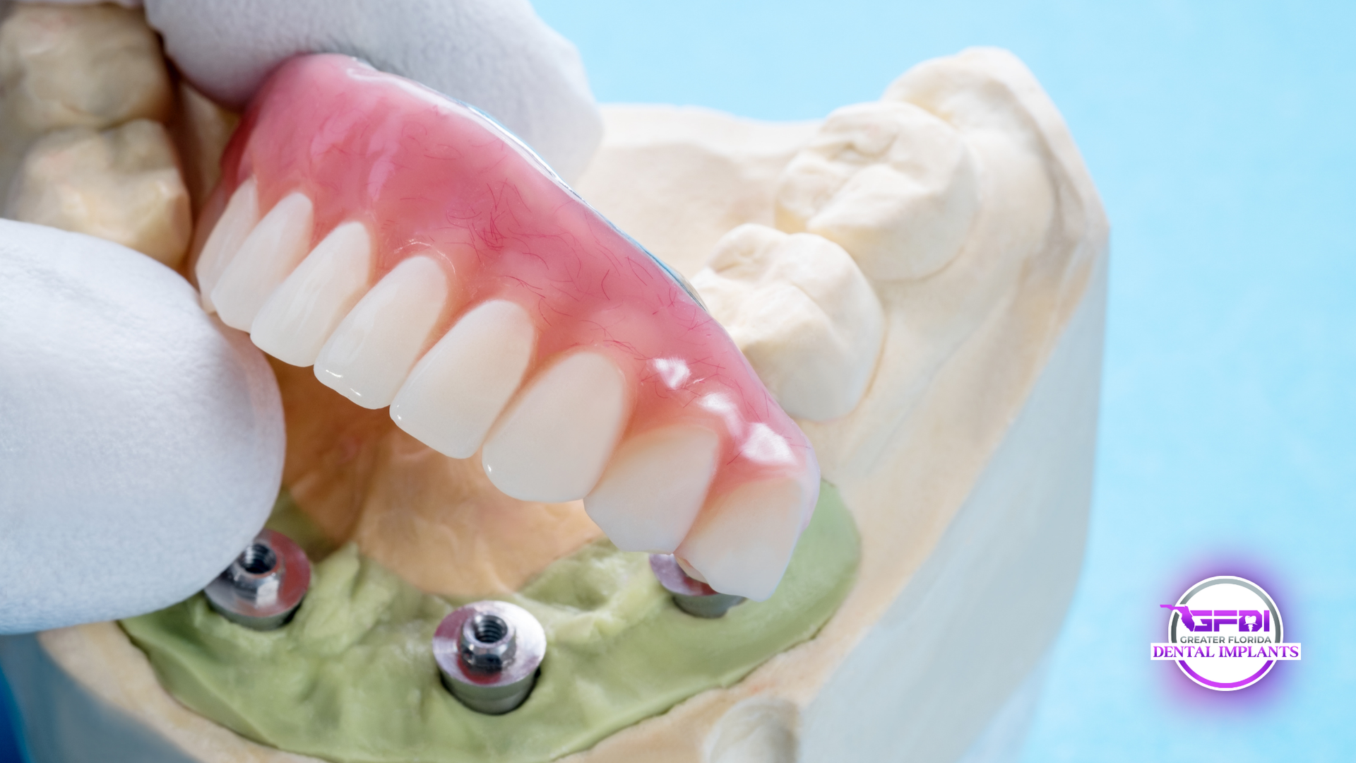 A denture is held above a dental model with metal posts, illustrating dental implant placement.