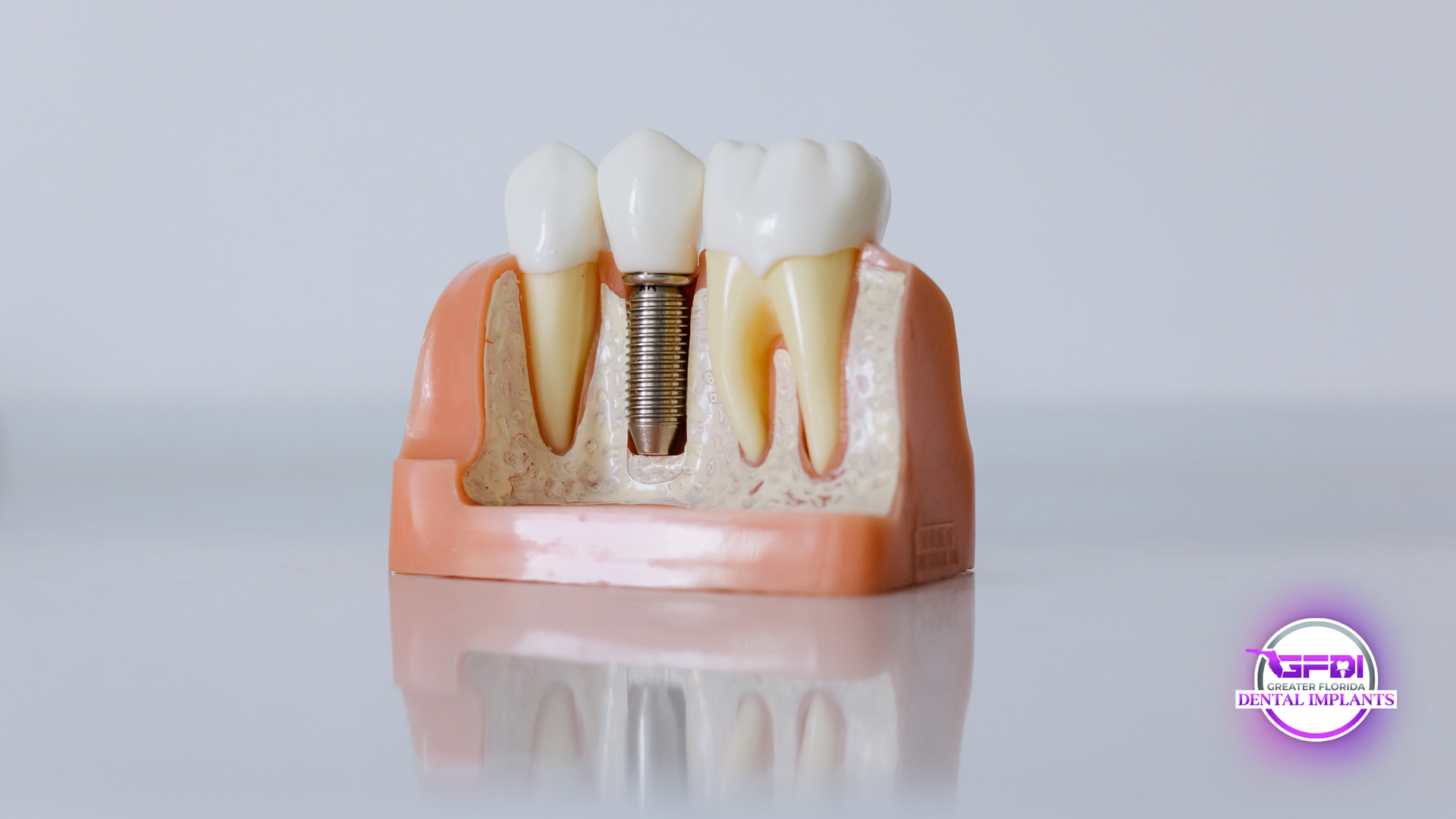 Dental model showcasing a tooth implant, with an adjacent natural tooth. The model is cut away to reveal the root structure.