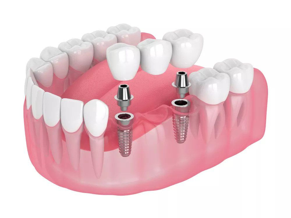 Cutaway view of dental implants with crowns bridging the gap where teeth are missing.