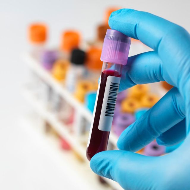 Blood sample being analyzed in a laboratory setting