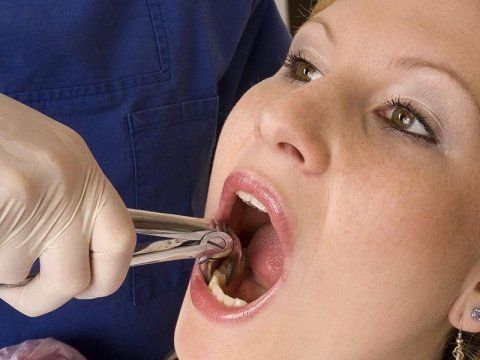 estrazioni dentali