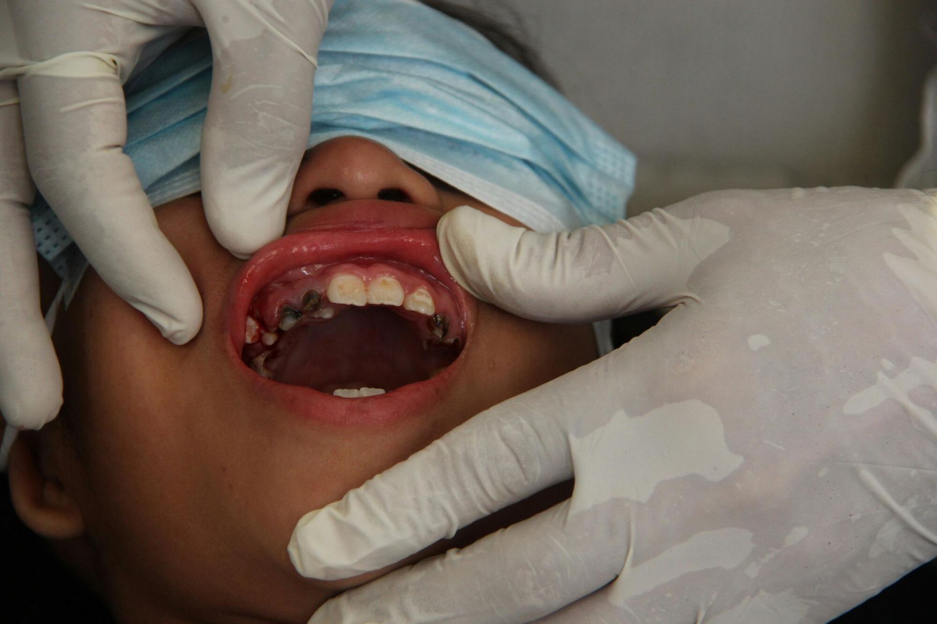 Dentist examining a child's teeth, open mouth. The child wears a face mask. Hands in white gloves.