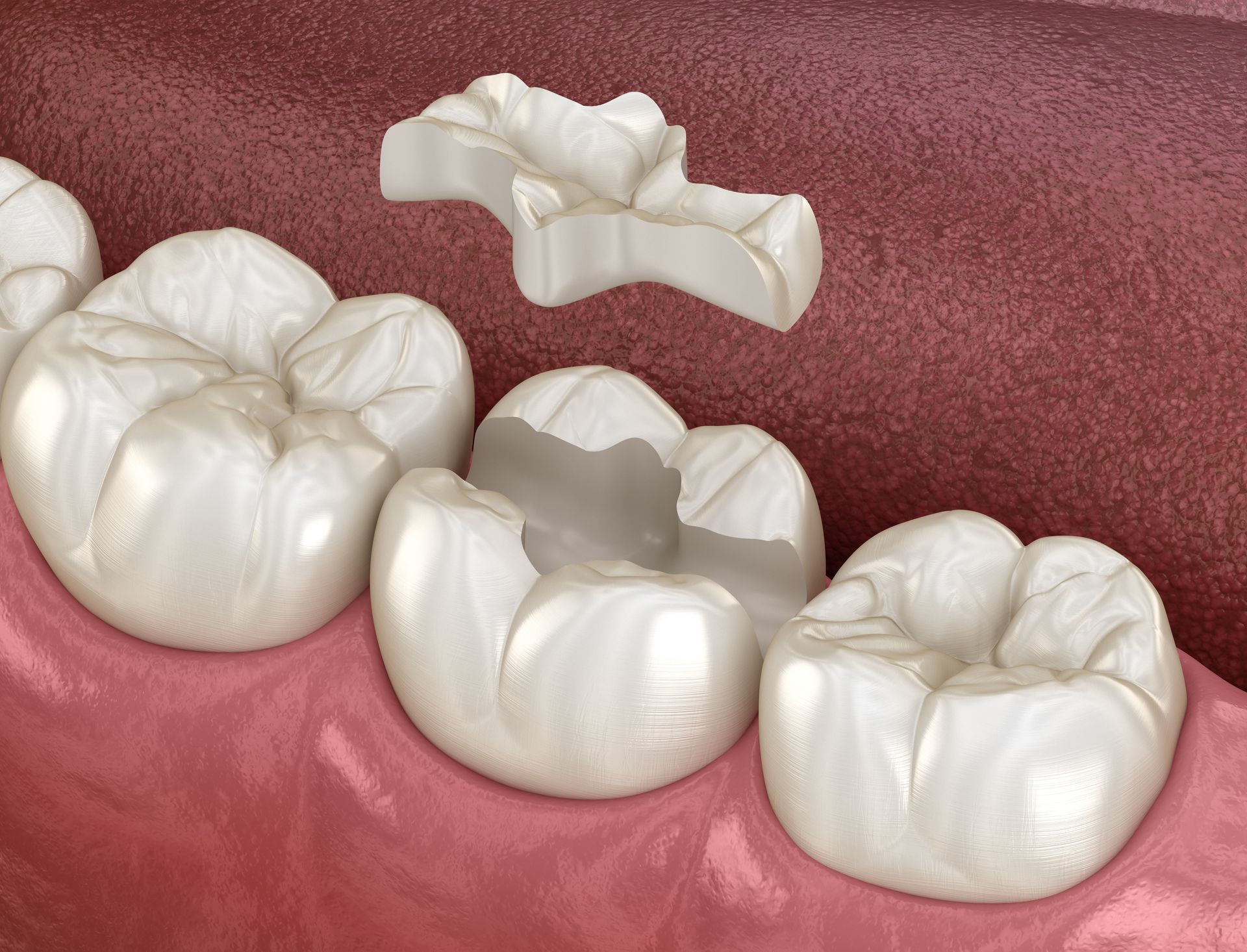 Inlays and Onlays: A Conservative Approach to Restoring Teeth