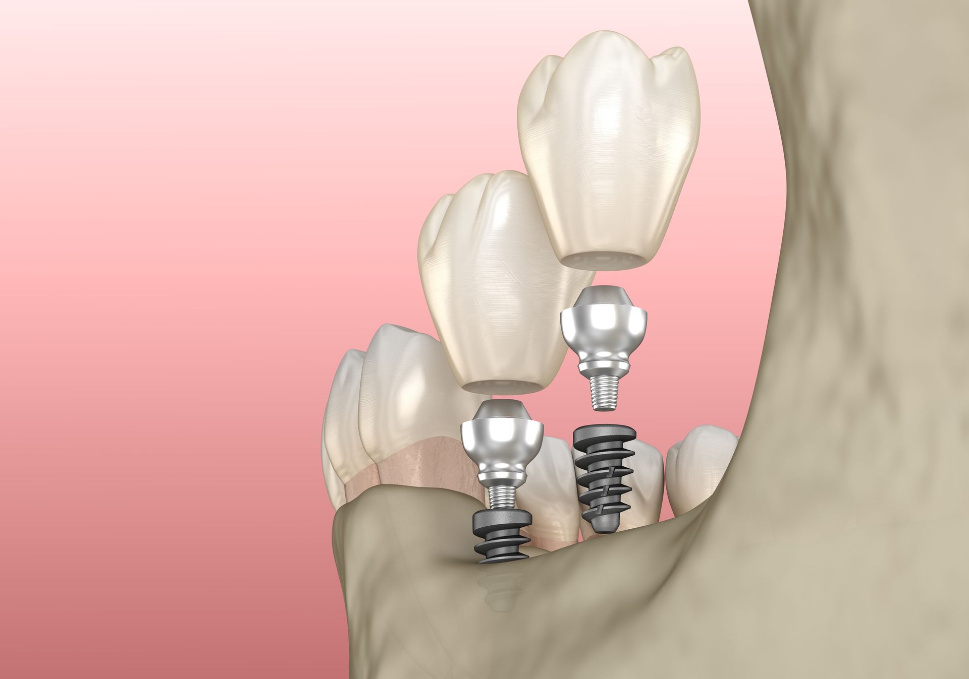 an illustration of a dental implant being placed in a tooth