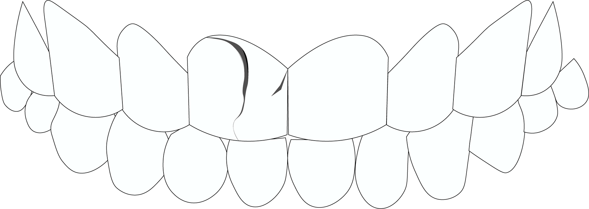 Cracked teeth