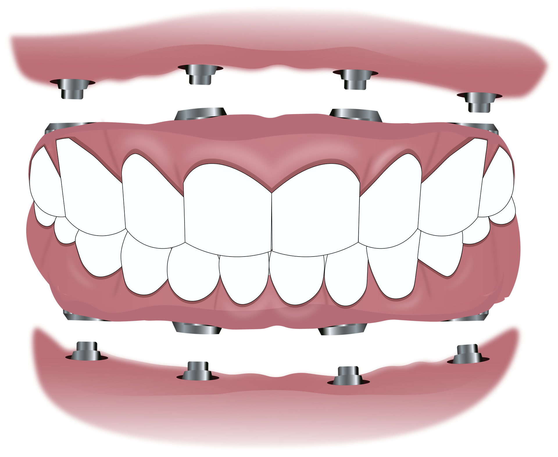 Fixed dentures