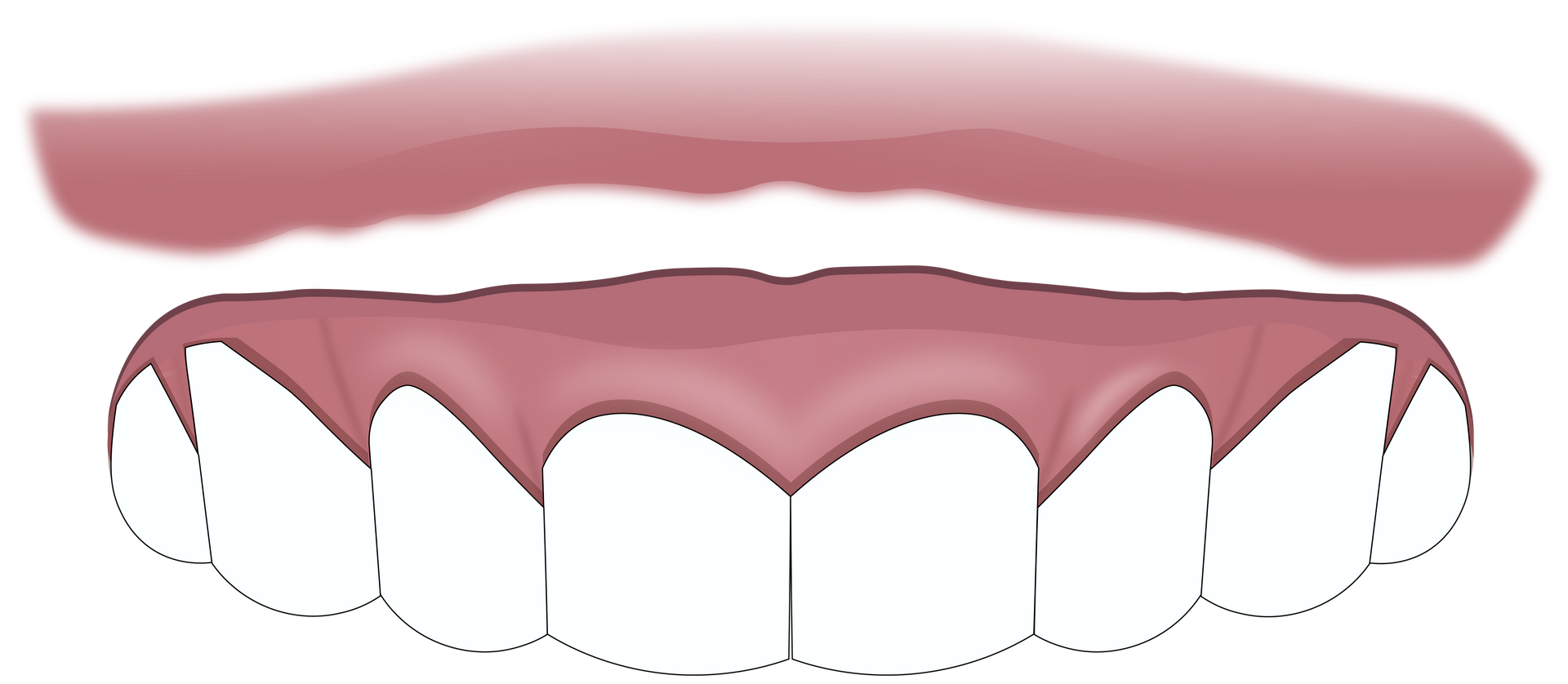 Removable dentures