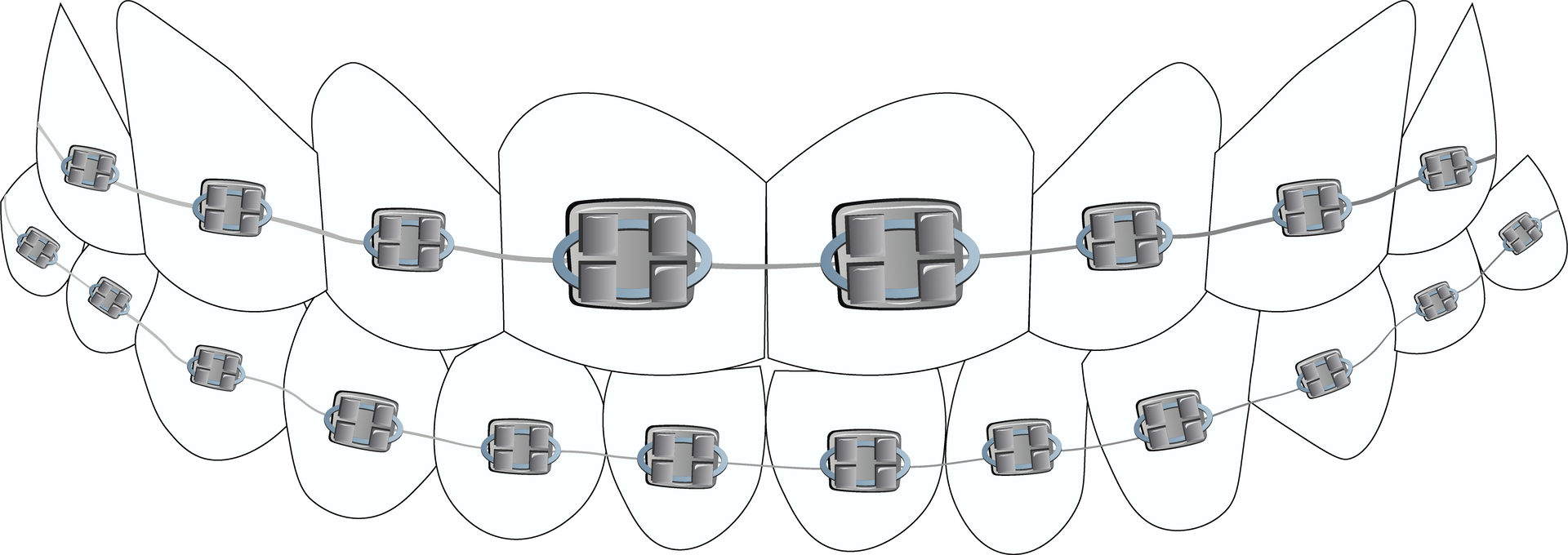 Un dibujo en blanco y negro de los dientes de una persona con aparatos ortopédicos.