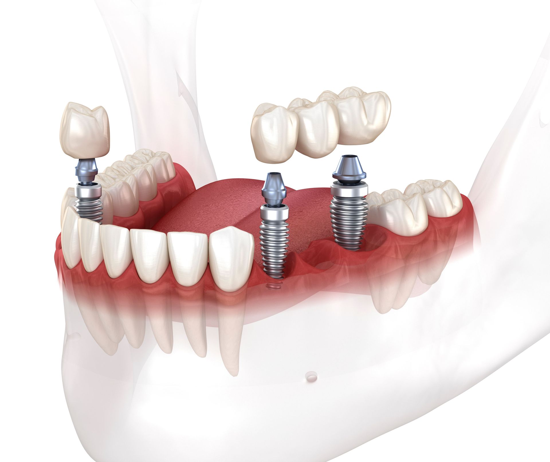 the benefit of dental implants vs dentures