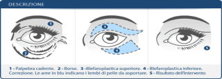 blefaroplastica occhi
