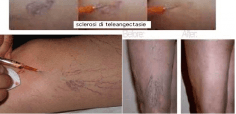 Trattamenti sclerosanti