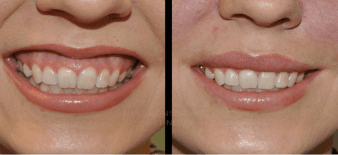 Chirurgia estetica delle labbra 2