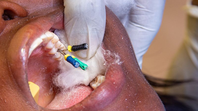 a dentist's patient getting a root canal procedure.