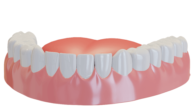 Lower teeth with dental veneers