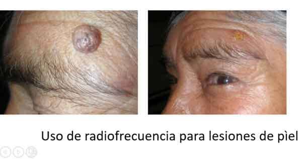 DR. RODRIGO CASTRO MARTÍNEZ - USO DE RADIOFRECUENCIA PARA LESIONES DE PIEL