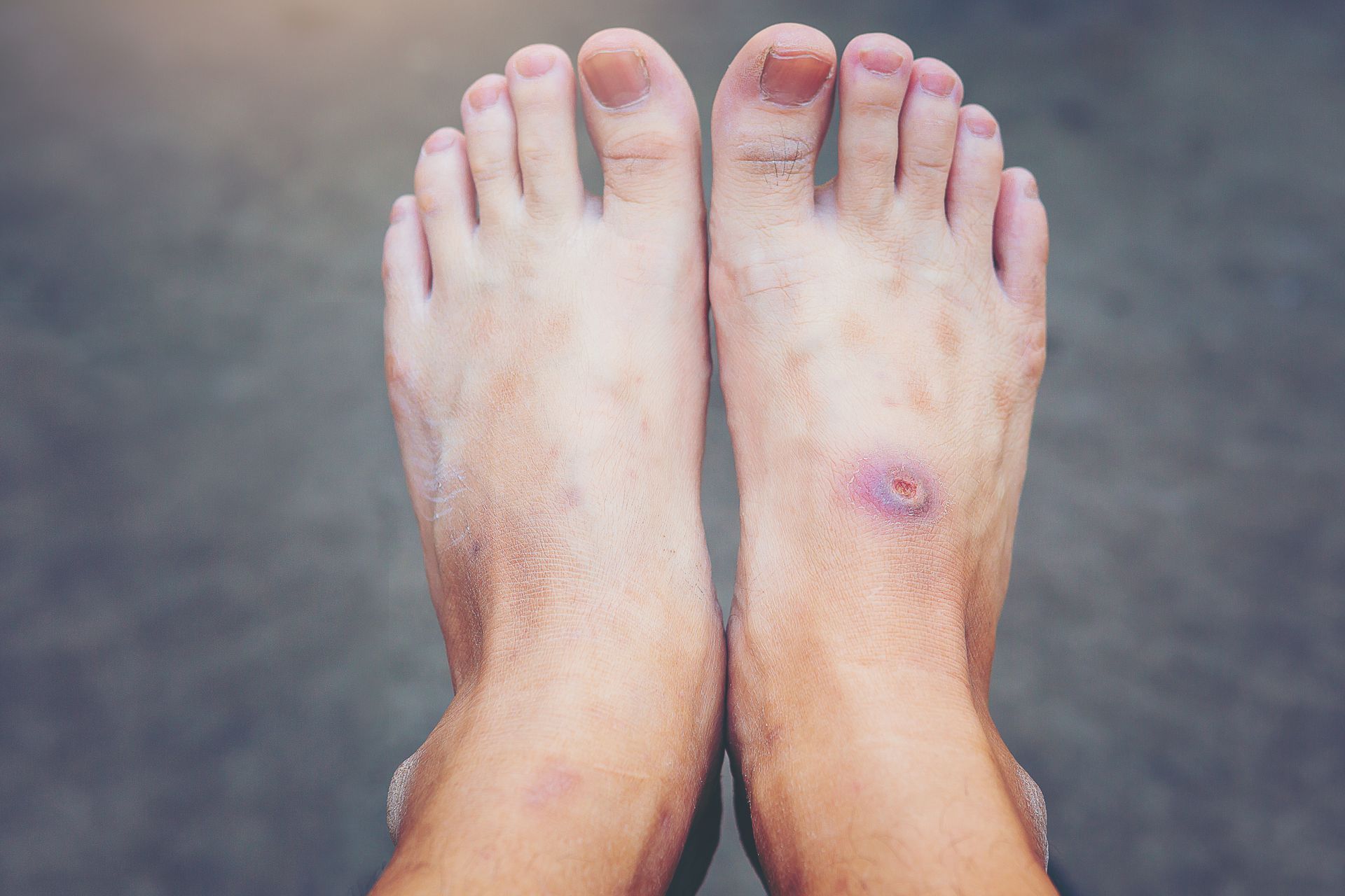 Two feet with a wound on the top of the right foot, on a gray background.
