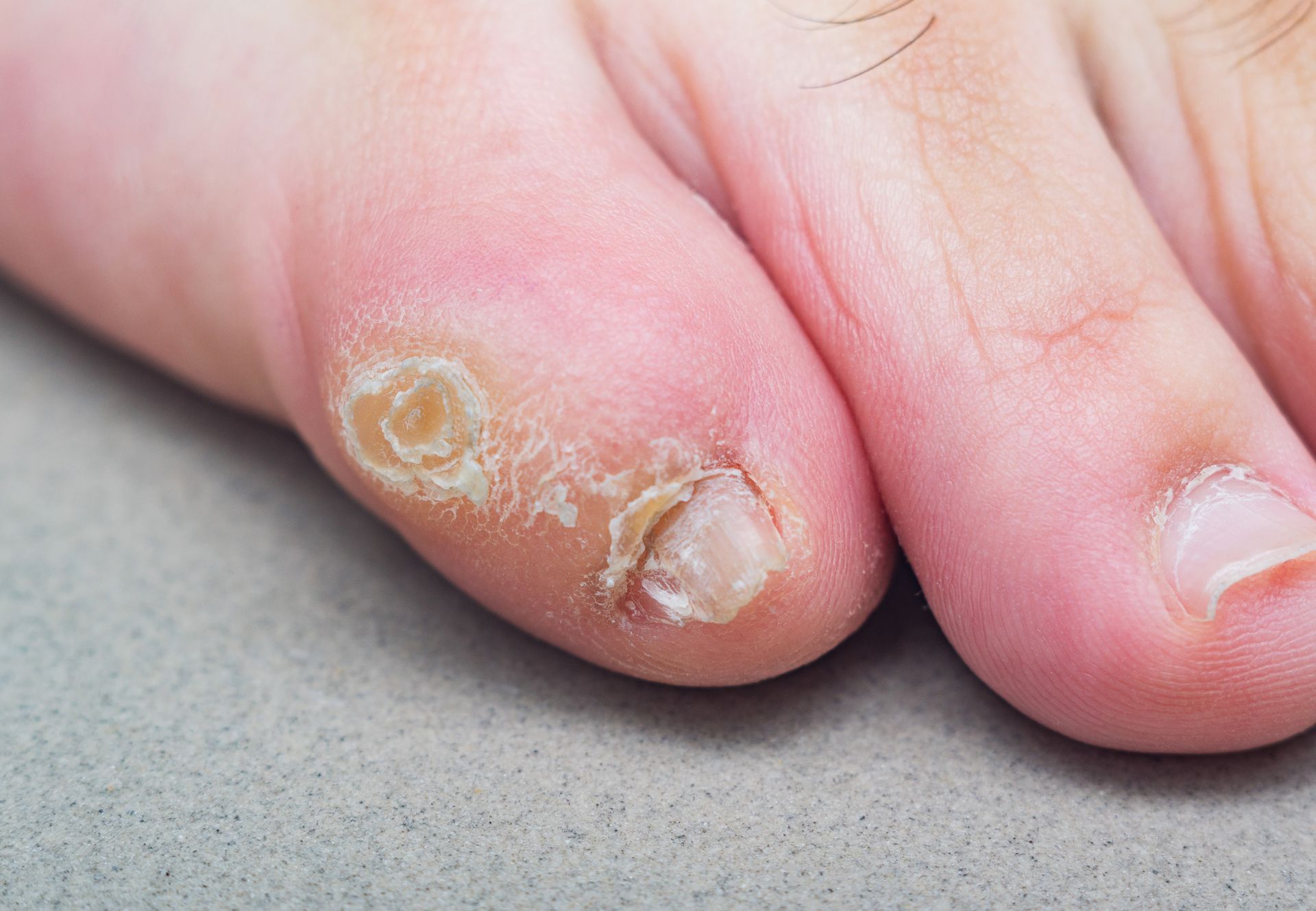 Close-up of a foot with a wart on the toe. The skin is pale, and the wart has a textured, yellowish appearance.