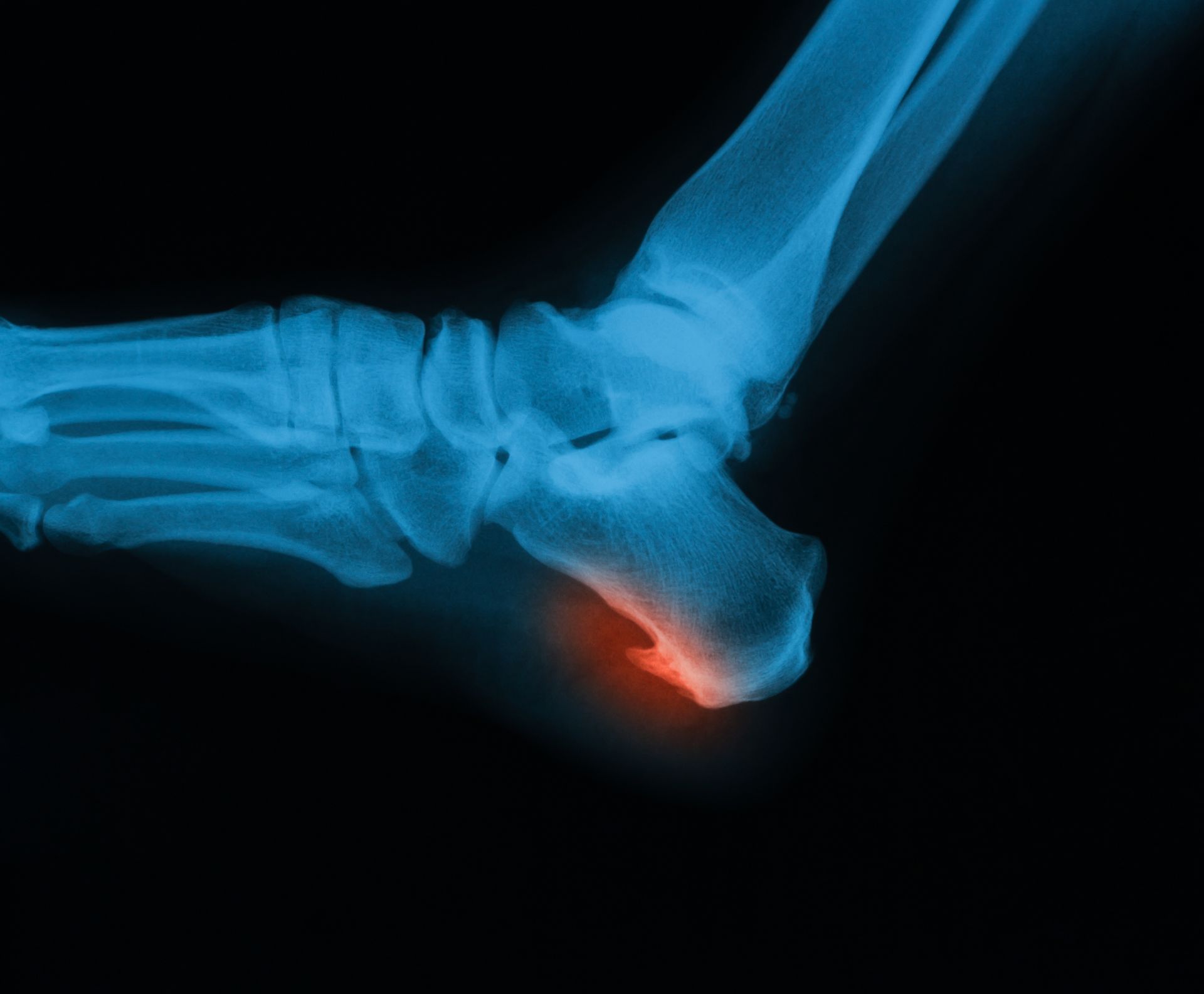 X-ray of a foot, showing a heel bone highlighted in red, possibly indicating an injury.