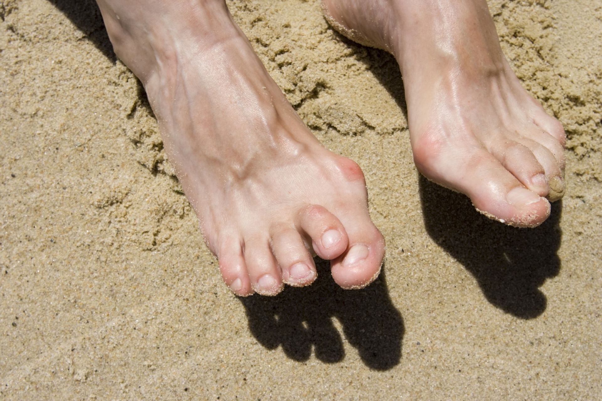 Feet with bunion on the sand; sunlight casts a shadow.