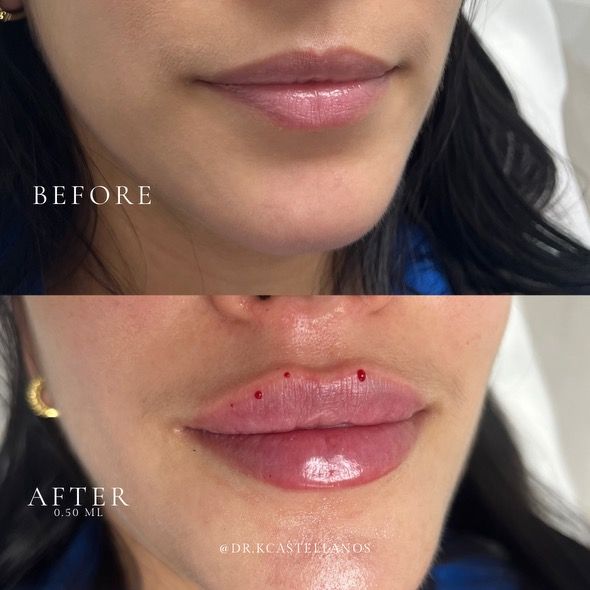 A before and after photo of a woman 's lips with the caption before and after