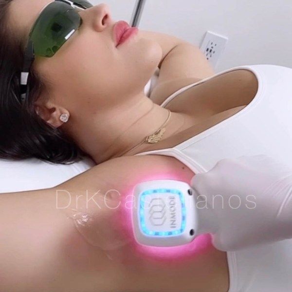 laser hair removal