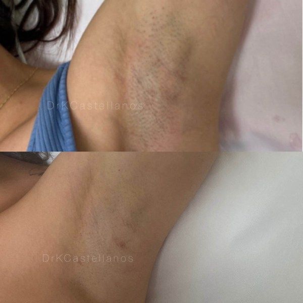 A before and after picture of a woman 's armpit