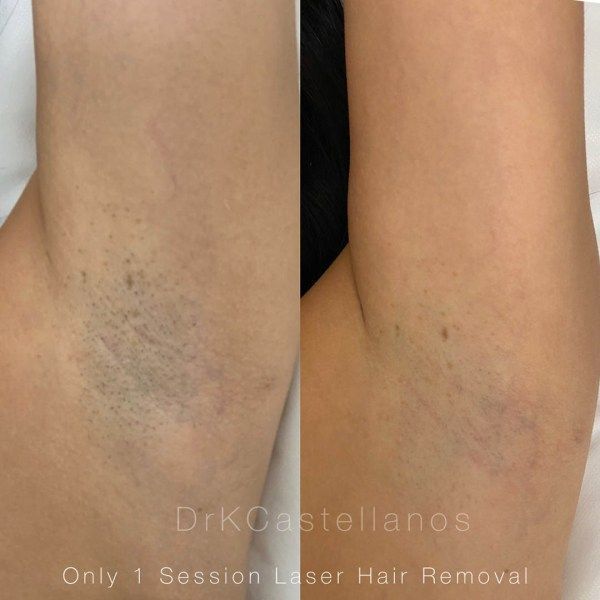 A before and after photo of a woman 's underarm hair removal