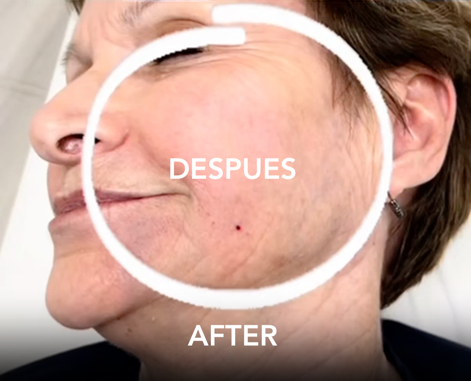 Close-up of a person's cheek profile with a small spot, circled with a white outline labeled