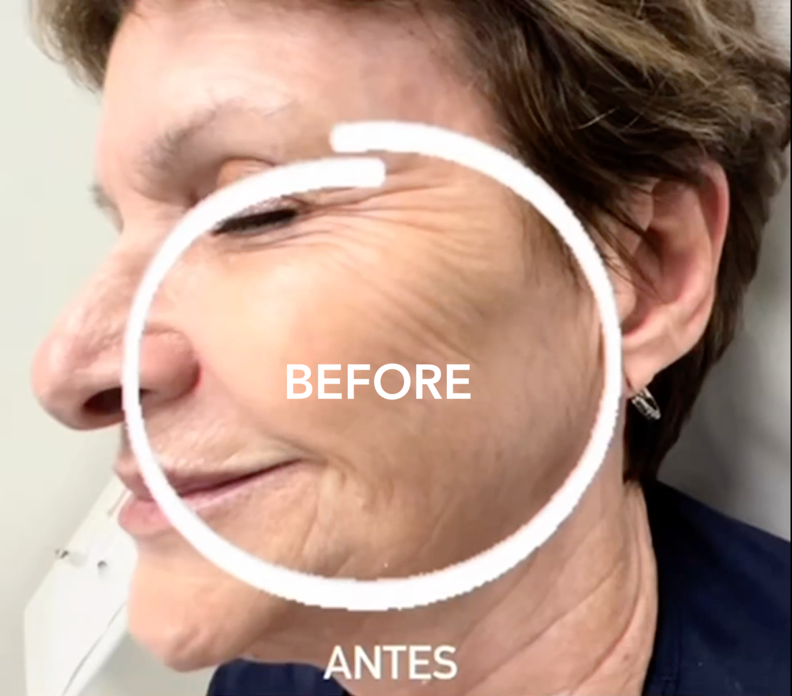 A profile view of a person’s face, highlighting fine lines and skin texture within a white circle labeled