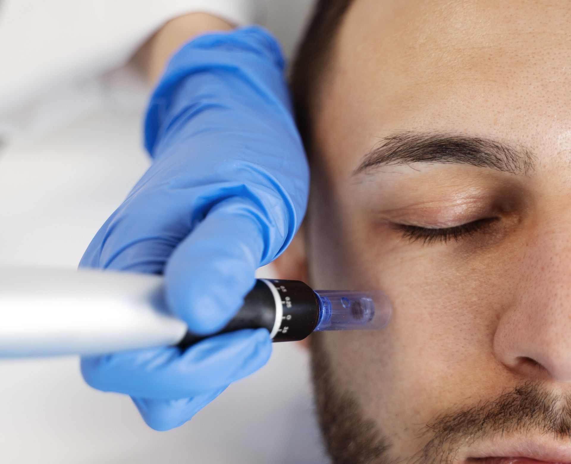 A person receiving a microneedling treatment on the cheek. A gloved hand holds a device near the face.