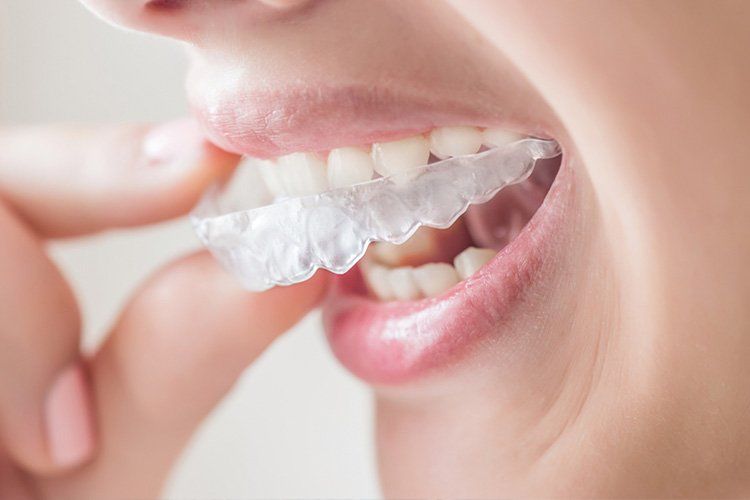 A woman is wearing a clear brace on her teeth.