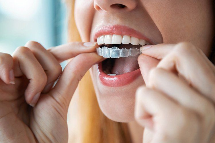 A woman is putting invisible braces on her teeth.