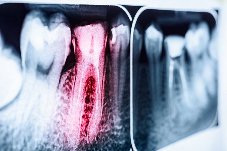 An x-ray of a tooth with a hole in it.