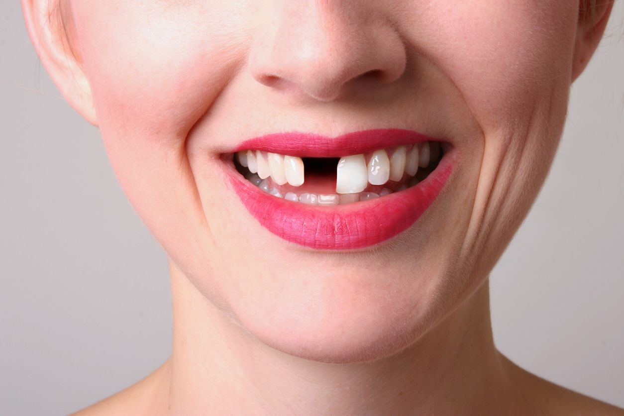 A close up of a woman 's mouth with a missing tooth.