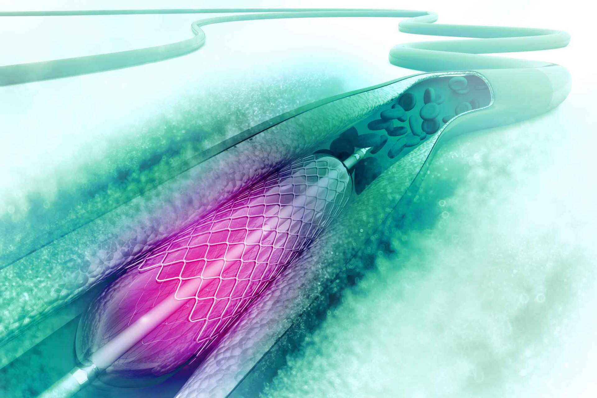 raffigurazione della chirurgia vascolare