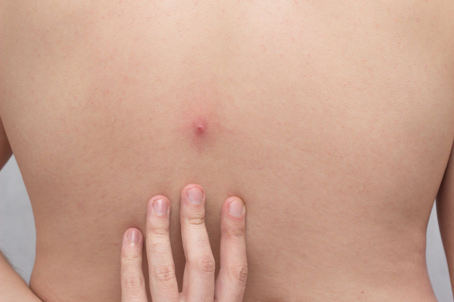 man pointing to abscess on back